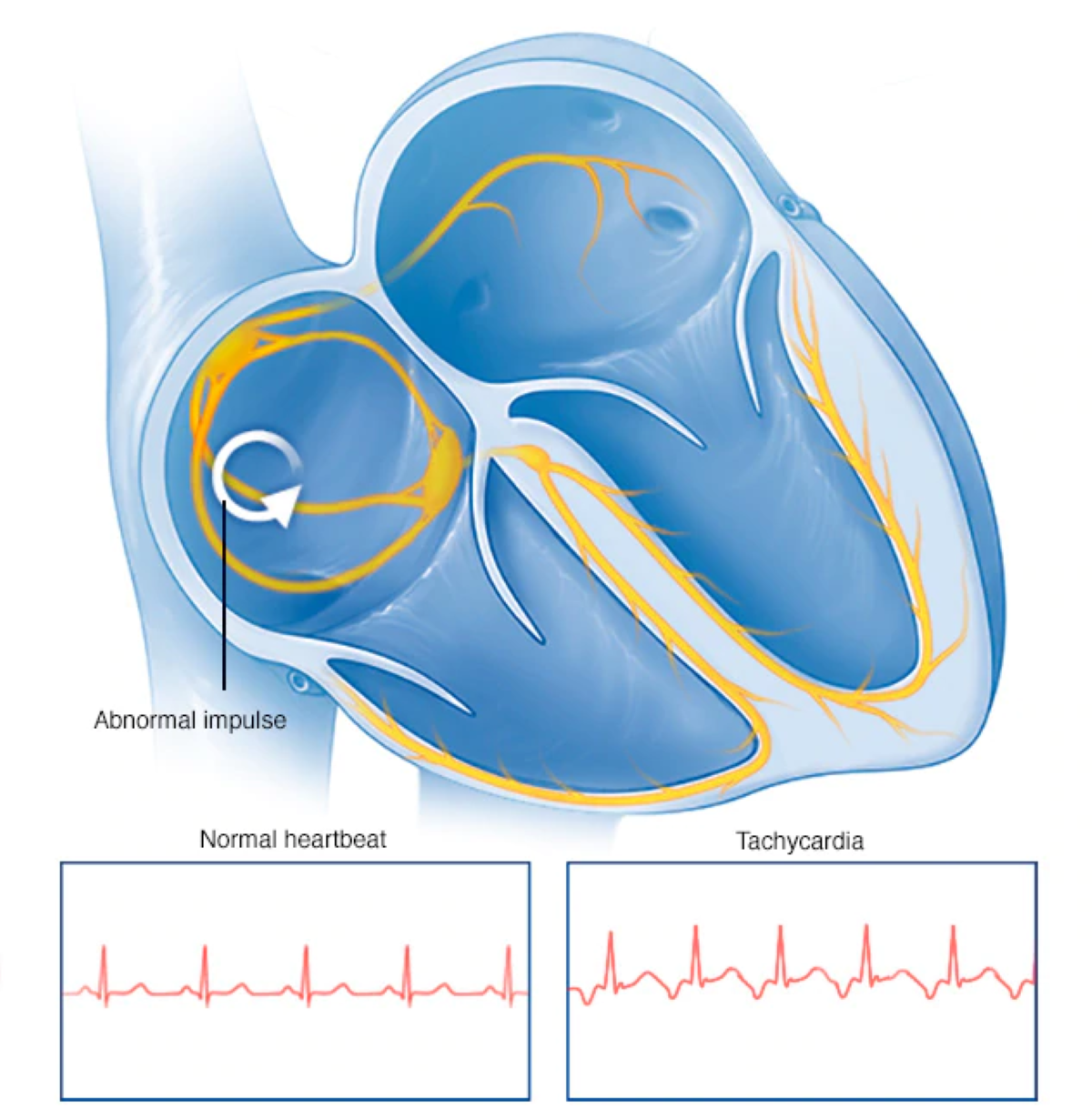 Tachycardia - Comparison between Normal and Tachycardia Heart Beat Graphics