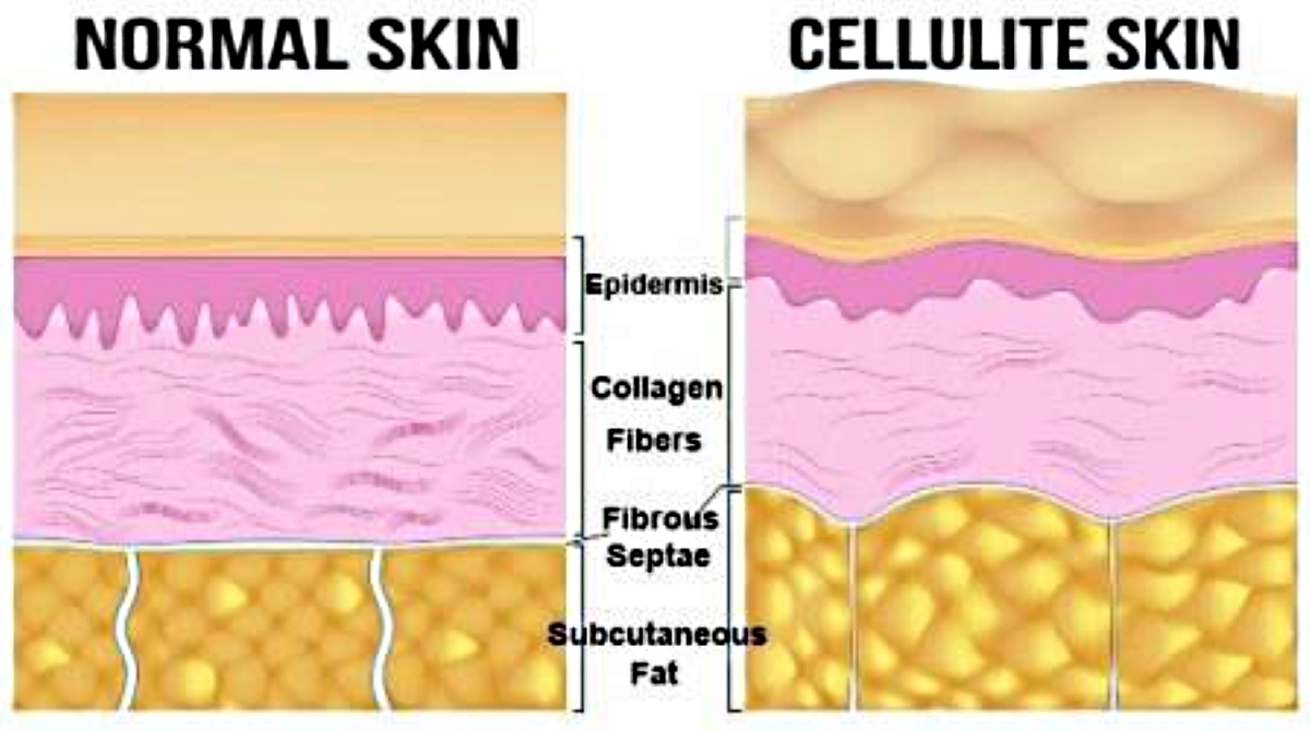 Normal Skin vs Cellulite Skin