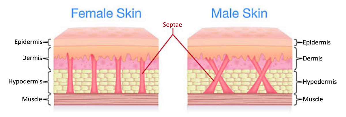 Normal Skin Fibrous Septae Bands vs Cellulite Skin Fibrous Septae Bands