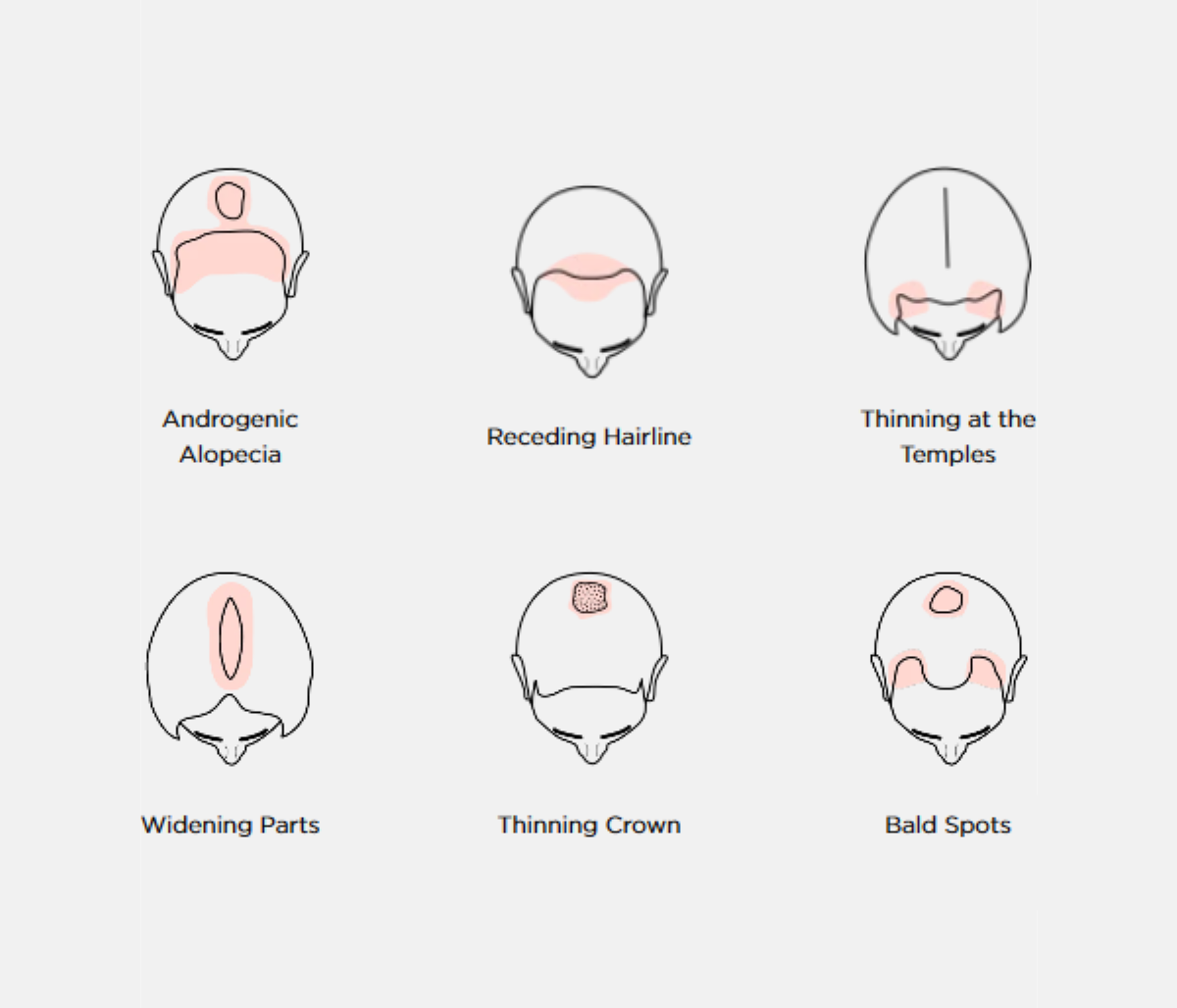 The iRestore Professional can help fight 6 Different Hair Loss Conditions