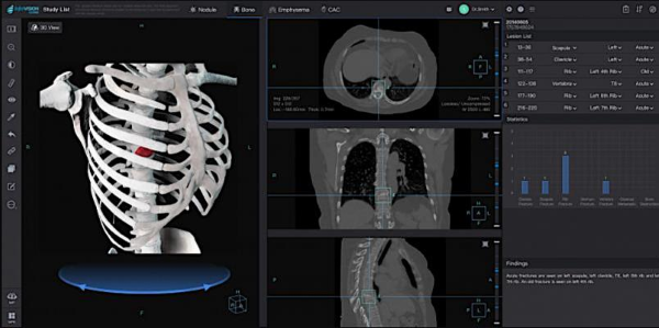 Infervision AI medical-tech solution to Diagnose Coronavirus on CT (Computed Tomography) Scans