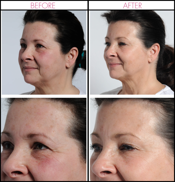 Incredible clinically proven benefits that help reduce both fine lines and wrinkles for visible results at home (Before & After)