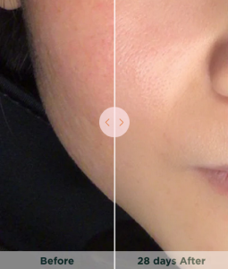 JOVS Blacken Photorejuvenation Device