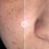 4. JOVS Blacken Photorejuvenation Device (9)